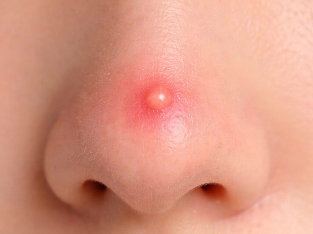 鼻子痘痘感染致命